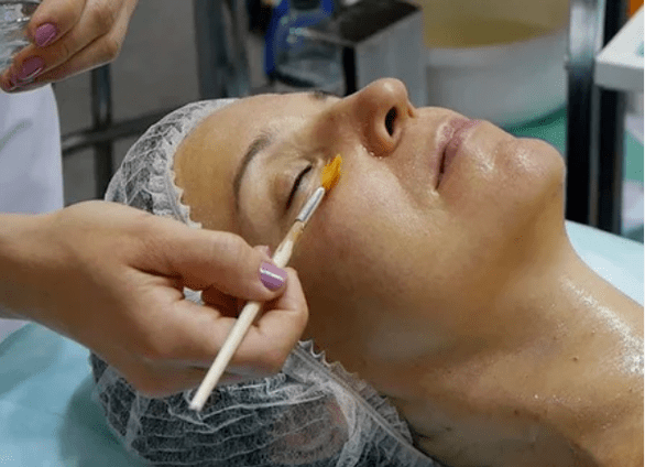 Chemické peeling