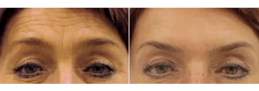 zařízení pro frakční omlazení