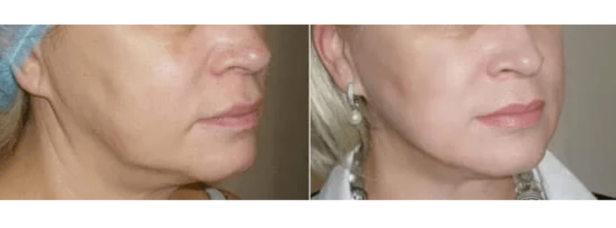 zotavení po omlazení pleti