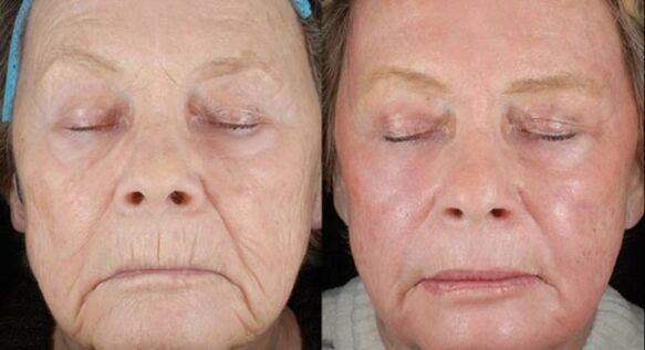 před a po laserové rejuvenaci
